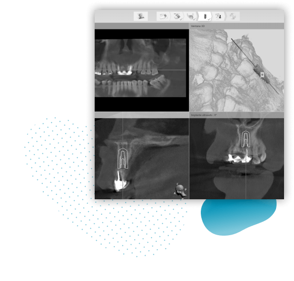 previaimplantcenter-implantes-dentales-all-on-4-recupera-tu-sonrisa