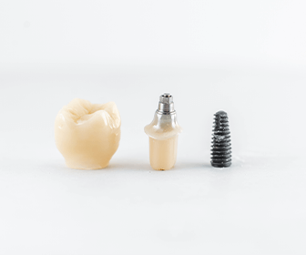 conoce-las-partes-de-un-implante-dental-que-mejoraran-tu-salud-previaimplantcenter