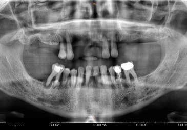 previaimplantcenter-antes-y-despues-clinica-de-implantes-dentales-en-tijuana-panoramica