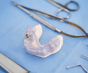 previaimplantcenter-especialista-en-implantes-dentales-en-tijuana