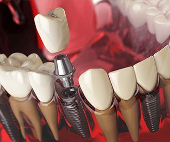 centro-de-implantes-dentales-en-tijuana-conoce-previaimplantcenter