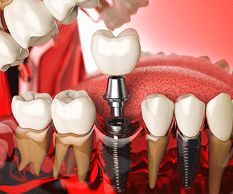 clinica-de-implantes-dentales-en-tijuana-conoce-previaimplantcenter