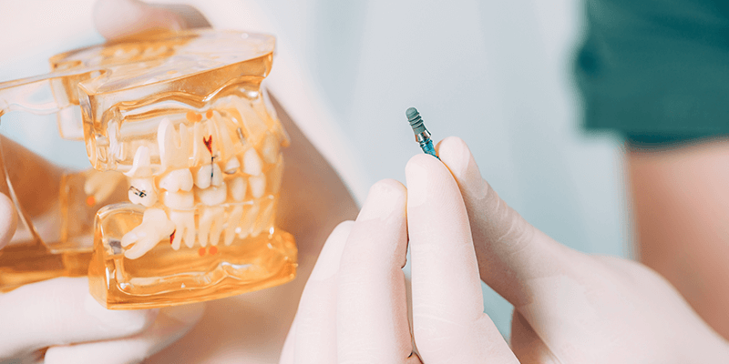 previaimplantcenter-cuanto-cuesta-un-implante-dental-en-tijuana