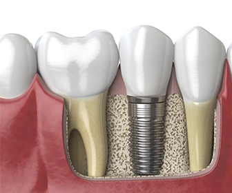 tipos-de-tecnicas-de-implantes-dentales-previa-implant-center-tijuana